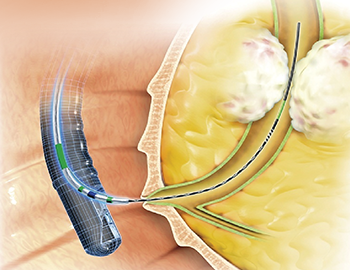 Anatomical illustration of straight guidewire being deployed from endoscope into common bile duct