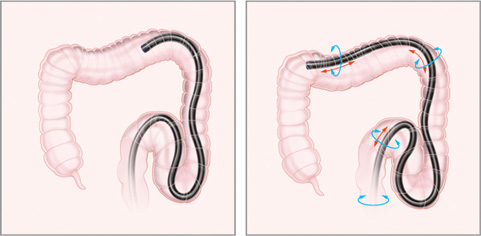Side-by-side illustration of GI tract scope inserted with arrows in the second image indicating motion within and around the organ