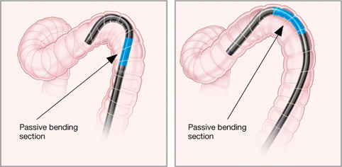 Side-by-side Illustration of GI tract scope inserted and arrow indicating passive bending section with the scope on the left in a candy-cane shape