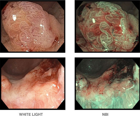 Two sets of side-by-side images comparing white light to NBI trademark