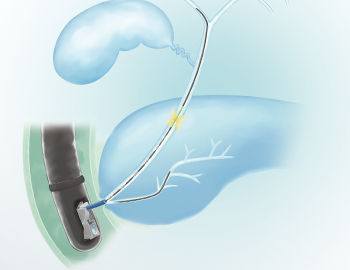 Anatomical illustration of angled guidewire being deployed from endoscope into common bile duct