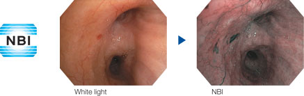 NBI trademark icon next to side-by-side images of bronchial surface comparing white light to NBI trademark