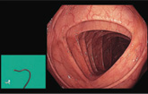 Thumbnail of simulated scope guide image in foreground with image of colon entrance in background