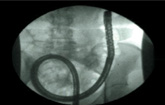 X-ray of scope inside of colon