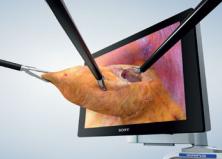 High-definition screen with 3D image of laparoscopic instruments manipulating tissue coming out of screen
