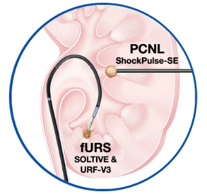 PCNL ShockPulse-SE | fURS SOLTIVE & URF-V3